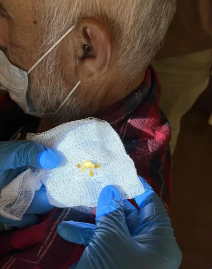 Patient undergoing ear cleaning procedure, with a close-up of the earwax on gauze,