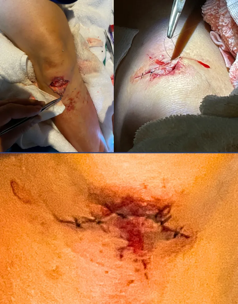 Collage of three images showing leg surgery with stitches and suture process