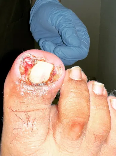 Close-up of an infected toenail.