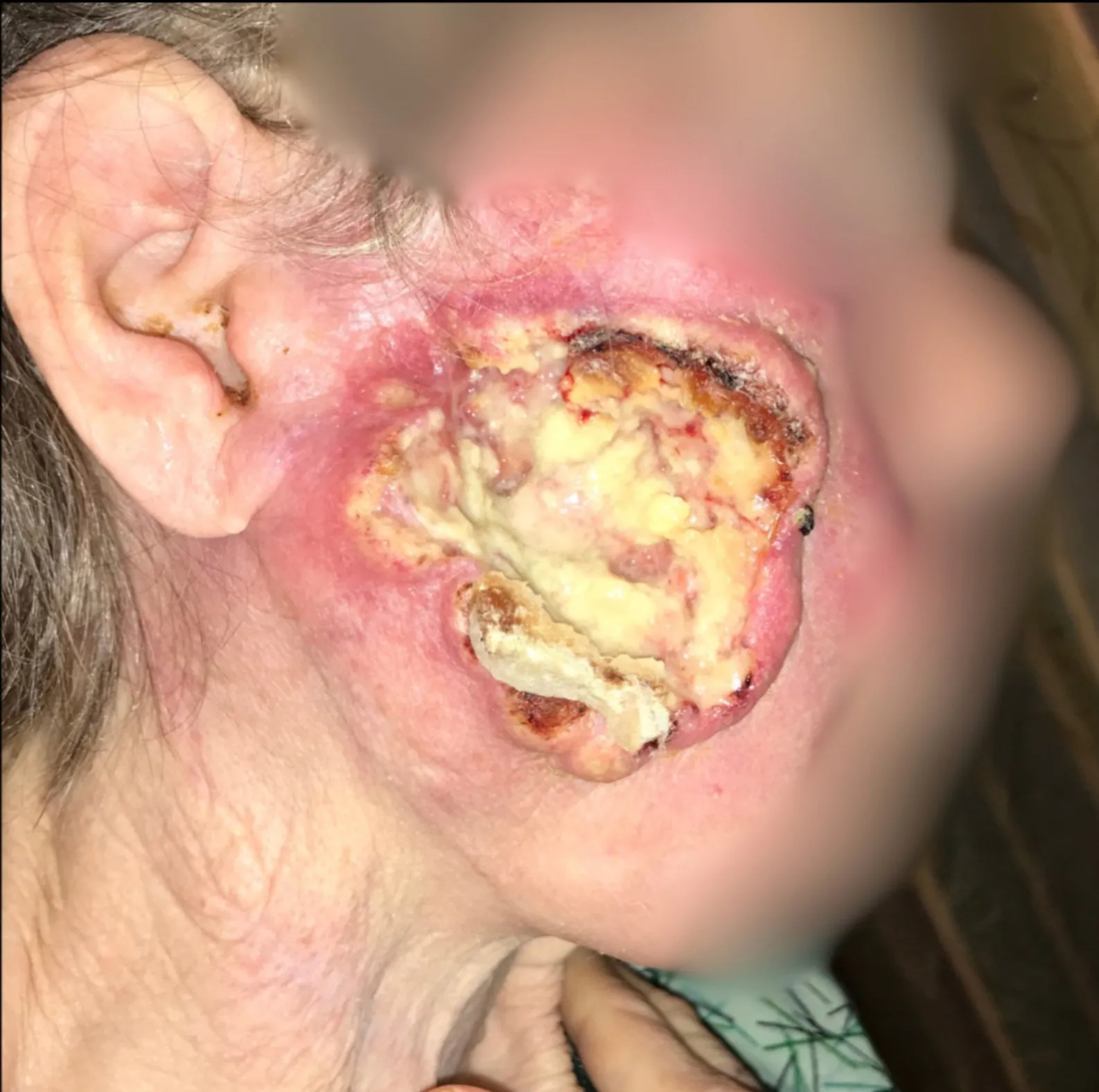 Conserved Patient 1: large ulcerated tumor on the cheek in front of the ear; the patient’s face is blurred for privacy.