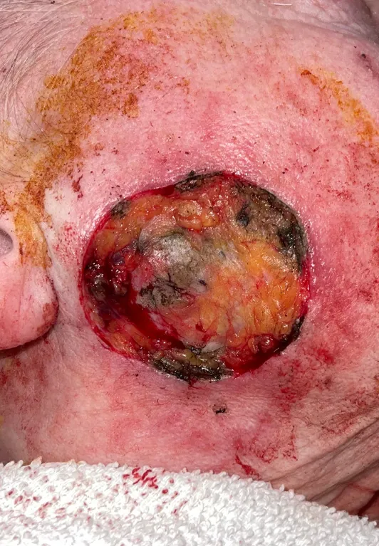 Conserved Patient 2 directly after bedside tumor removal: open circular surgical wound on the cheek, January 5, 2023.