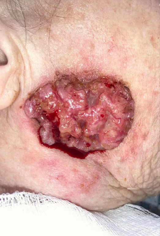 Conserved Patient 2 before treatment: large ulcerated tumor on the cheek, January 5, 2023.