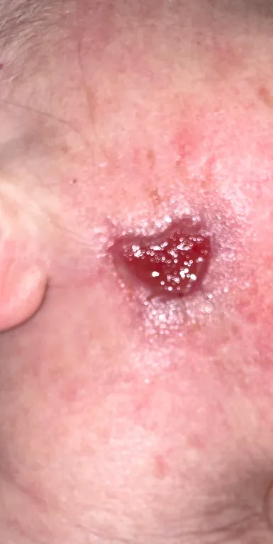 Conserved Patient 2 during healing: small remaining wound on the cheek, February 15, 2023.