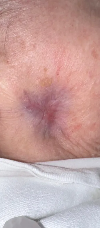 Conserved Patient 2 after healing: closed skin on the cheek with mild residual discoloration, April 1, 2023.