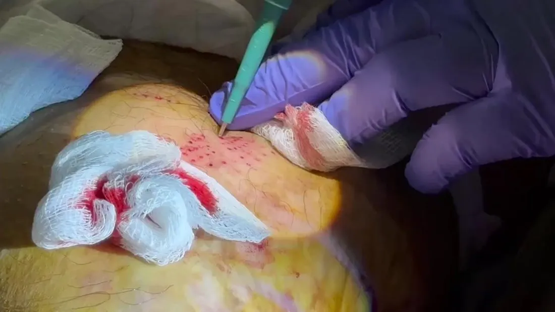 Punch biopsy tool placing small skin grafts into a wound